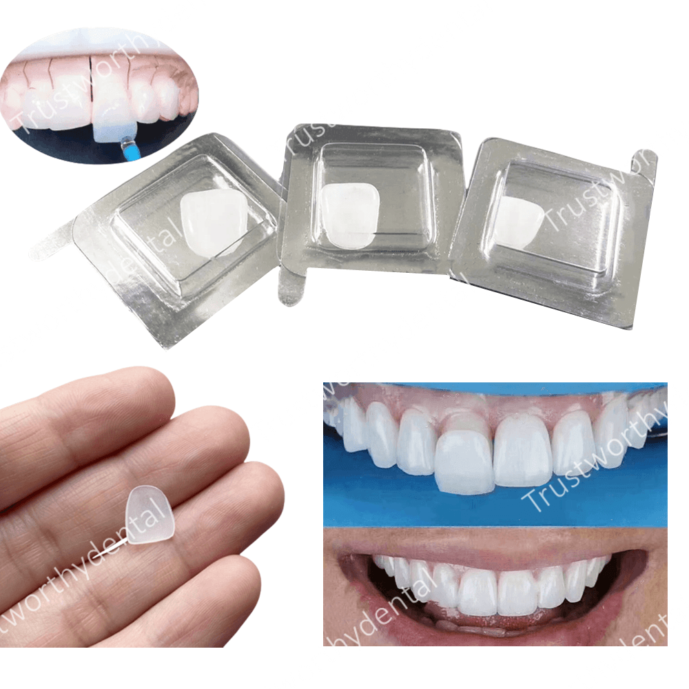 Teeth Paint Whitening - Dental Composite Porcelain Veneer Whitening Front