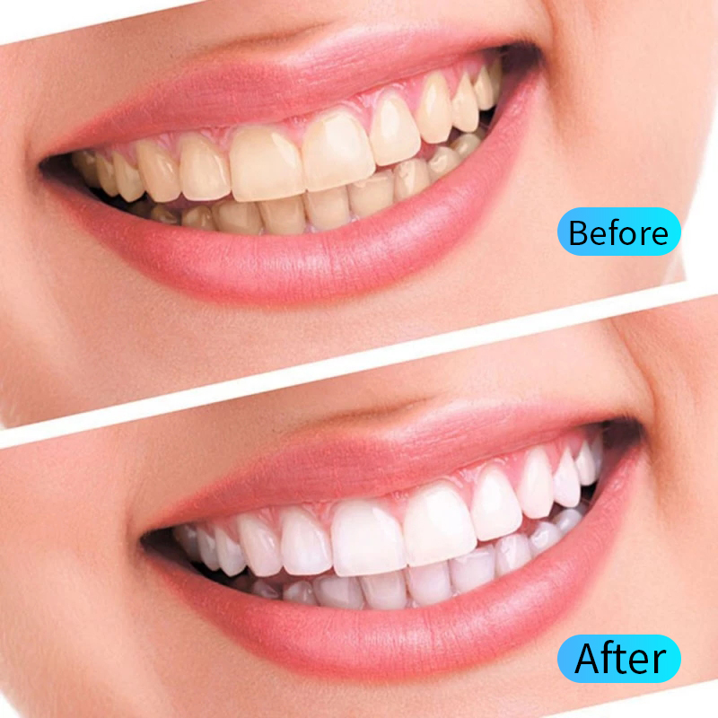 Teeth Whitening Gel Kit Oral H - đánh giá và giá Teeth Whitening Kit At Home