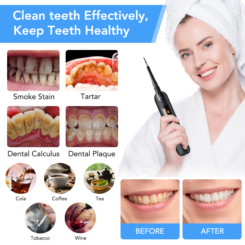 Teeth Tartar Remover Electric  - đánh giá và giá Teeth Whitening Kit At Home