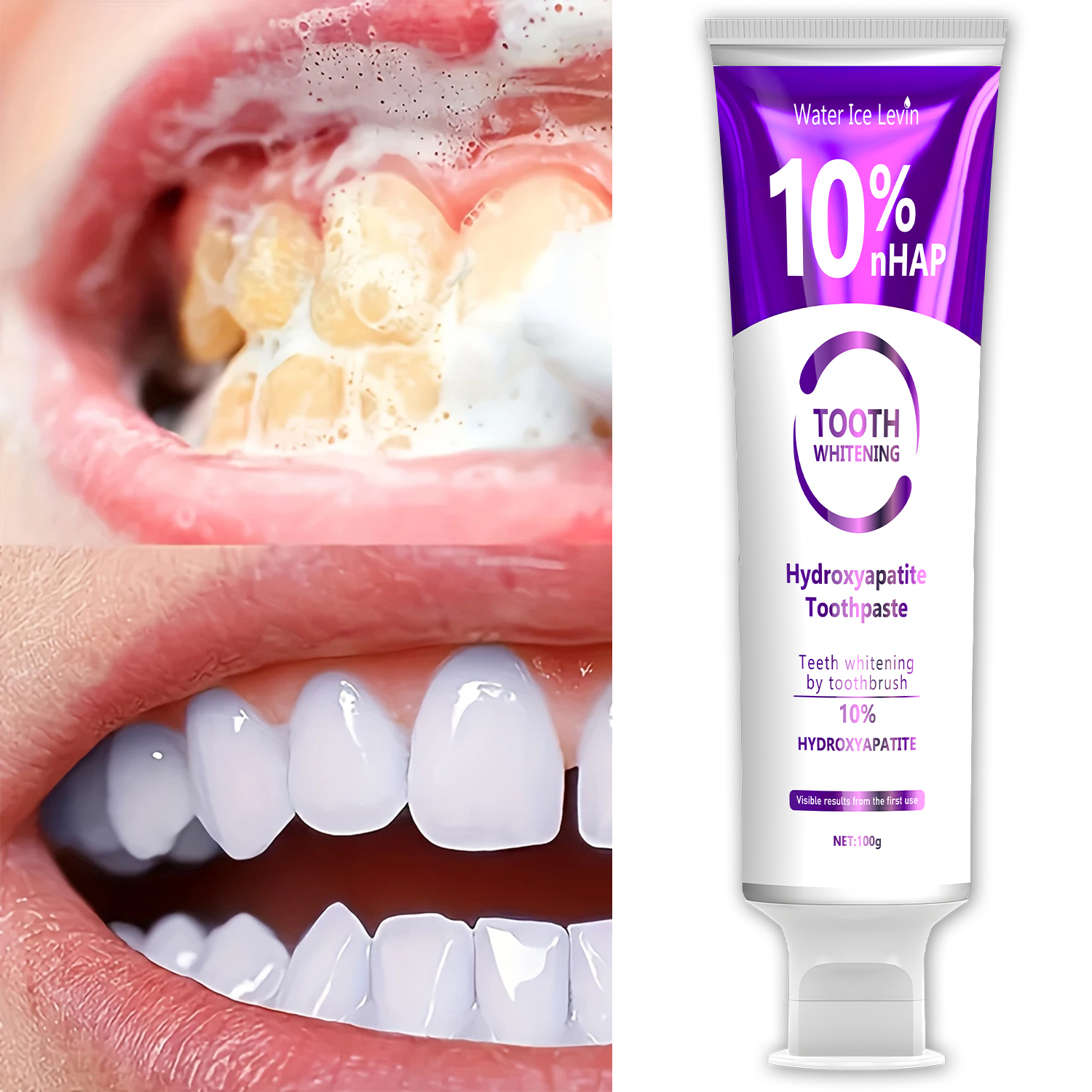 10% Nanoh Hydrogen Oxide Tooth - đánh giá và giá Teeth Whitening With Peroxide