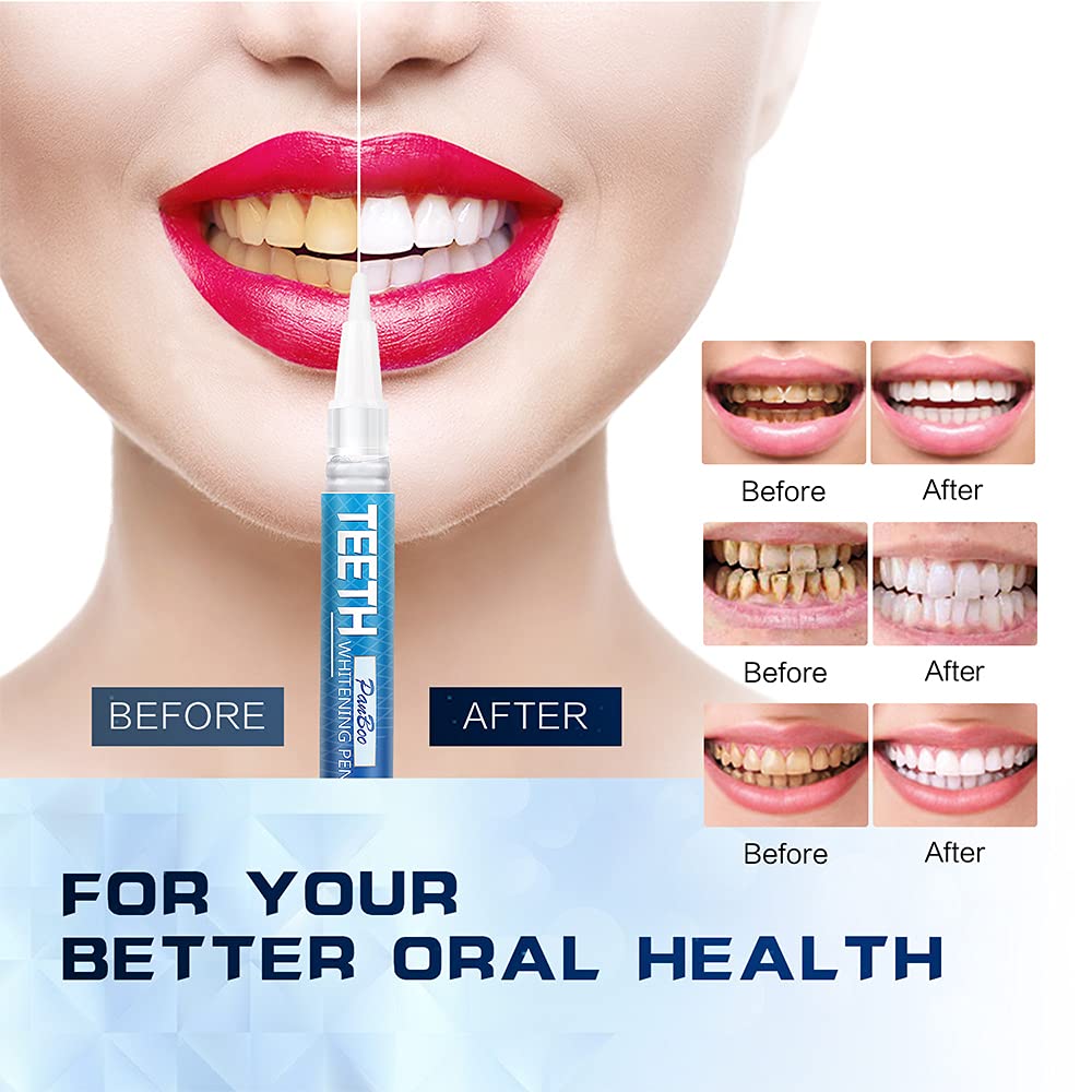 Teeth Whitening Pen Remove Cof - đánh giá và giá Teeth Whitening Kit At Home