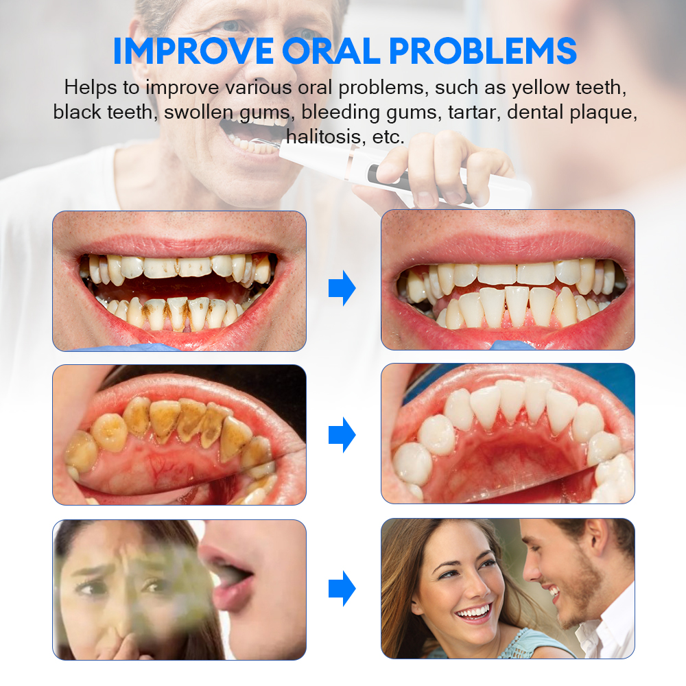 Electric Ultrasonic Dental Sca - đánh giá và giá Teeth Whitening Express