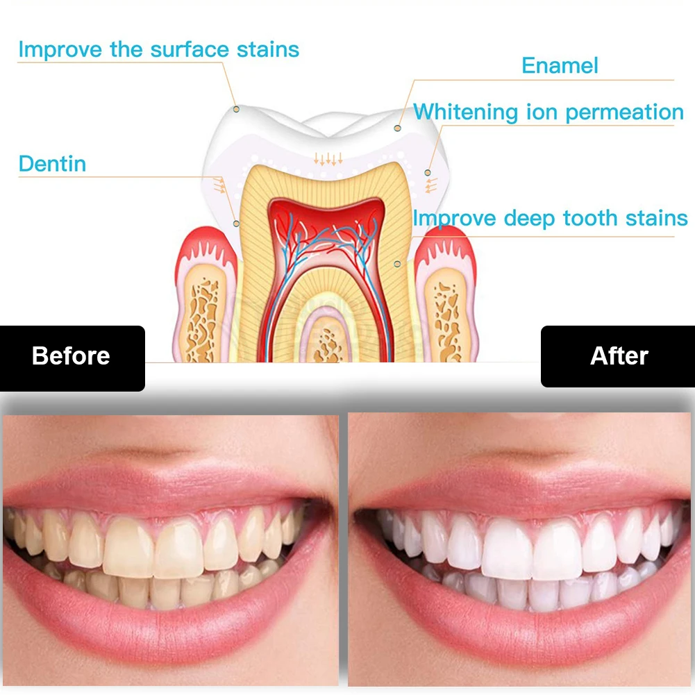Dental Teeth Whitening Kit Min - đánh giá và giá Teeth Whitening With Peroxide
