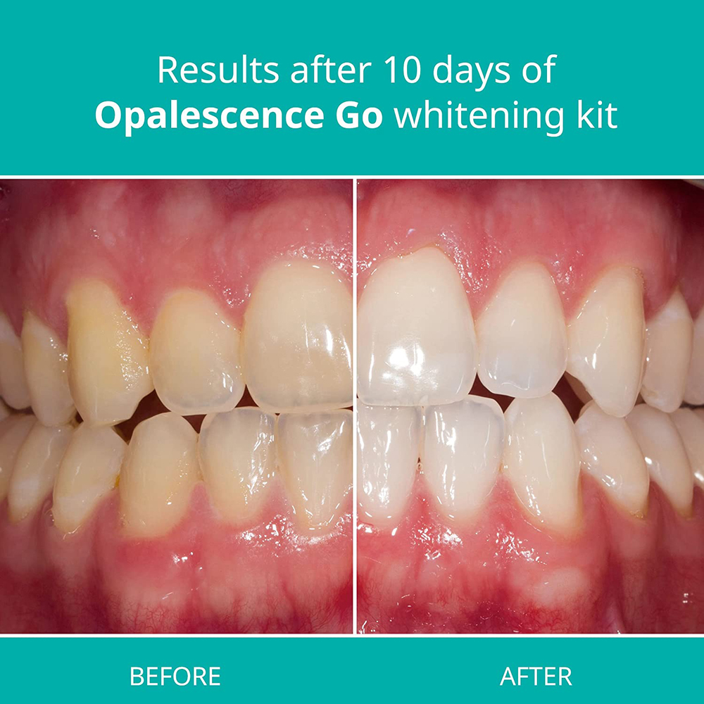 Opalescence Go Teeth Whitening - đánh giá và giá Teeth Whitening Kit At Home